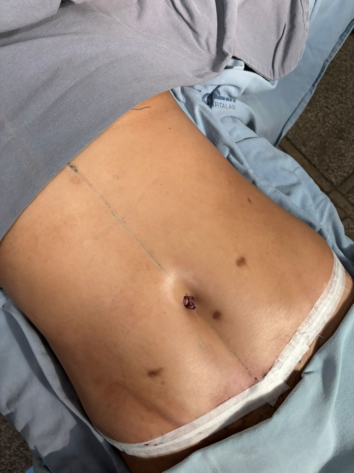 Resultado após cirurgia - Caso 3